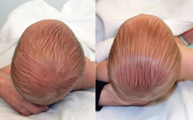 xoa-tre-bi-meo-dau-1